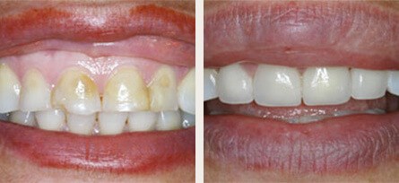 Young Patient Revitalizes Smile with Veneers - Before and after image 1 of 1