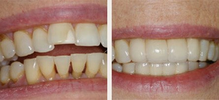 Porcelain Veneer Before and After Results from Southern Cal Smiles - Before and after image 1 of 1