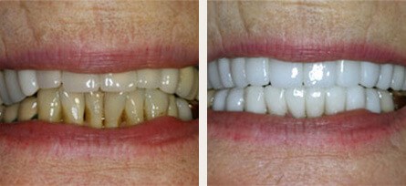 Full mouth porcelain veneers and crowns gives Tarzana, CA woman a big emotional boost - Before and after image 1 of 1