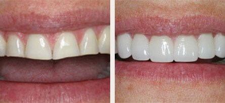 West Hills lady who wished to improve her smile and confidence - Before and after image 1 of 1