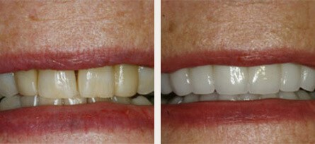 Smile Makeover / Full Mouth Restoration Before and After - Before and after image 1 of 1