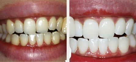 Laser Teeth Whitening Transforms Smile - Before and after image 1 of 1