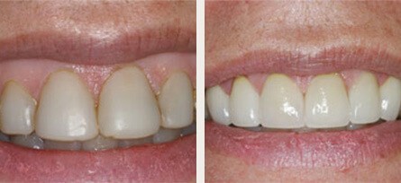 Teeth Whitening Before & After - Before and after image 1 of 1