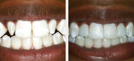 Woodland Hills, CA man gets conservative bonding on 4 teeth - Before and after image 1 of 1