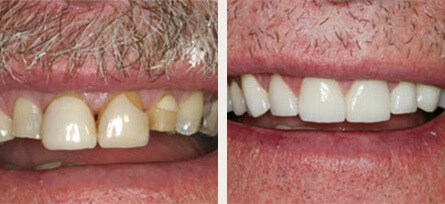 Smile Makeover on Calabasas, CA Dental Patient - Before and after image 1 of 1