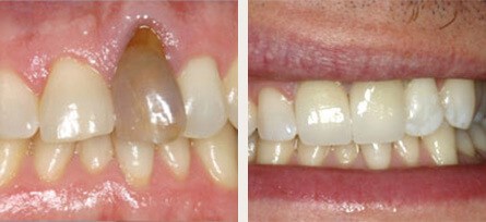 Woodland Hills & Calabasas Dentist Transforms Patient Smile with just two teeth! - Before and after image 1 of 1