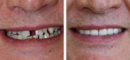 Smile Makeover Dental Patient in Woodland Hills, CA - Before and after image 1 of 1