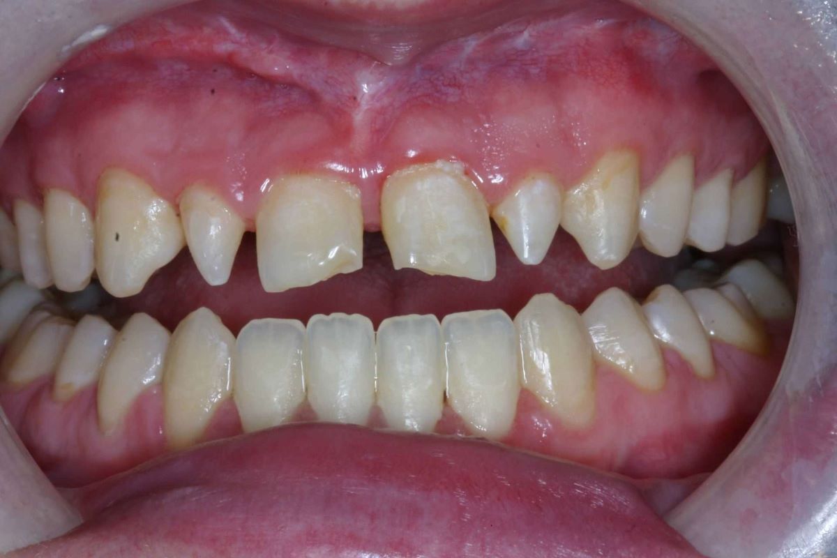 Modern Dentistry can overcome & create perfection! Come see us in Woodland Hills - Before and after image 1 of 6