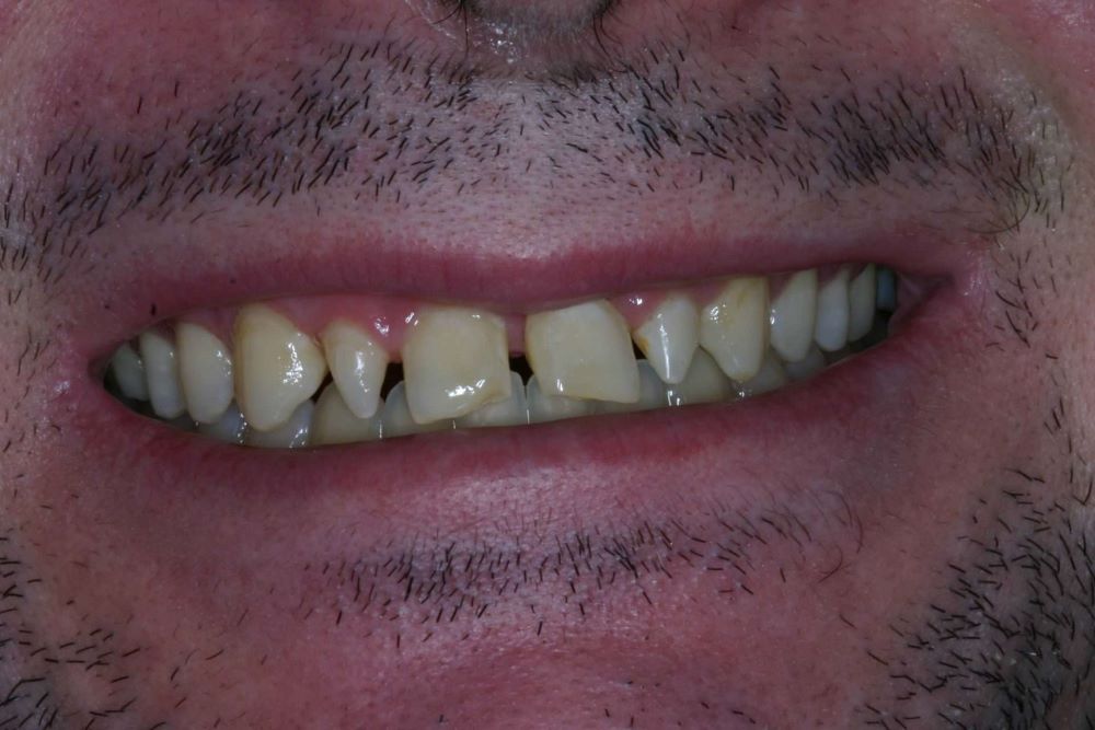Modern Dentistry can overcome & create perfection! Come see us in Woodland Hills - Before and after image 3 of 6