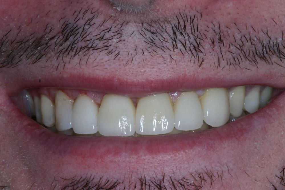Modern Dentistry can overcome & create perfection! Come see us in Woodland Hills - Before and after image 4 of 6