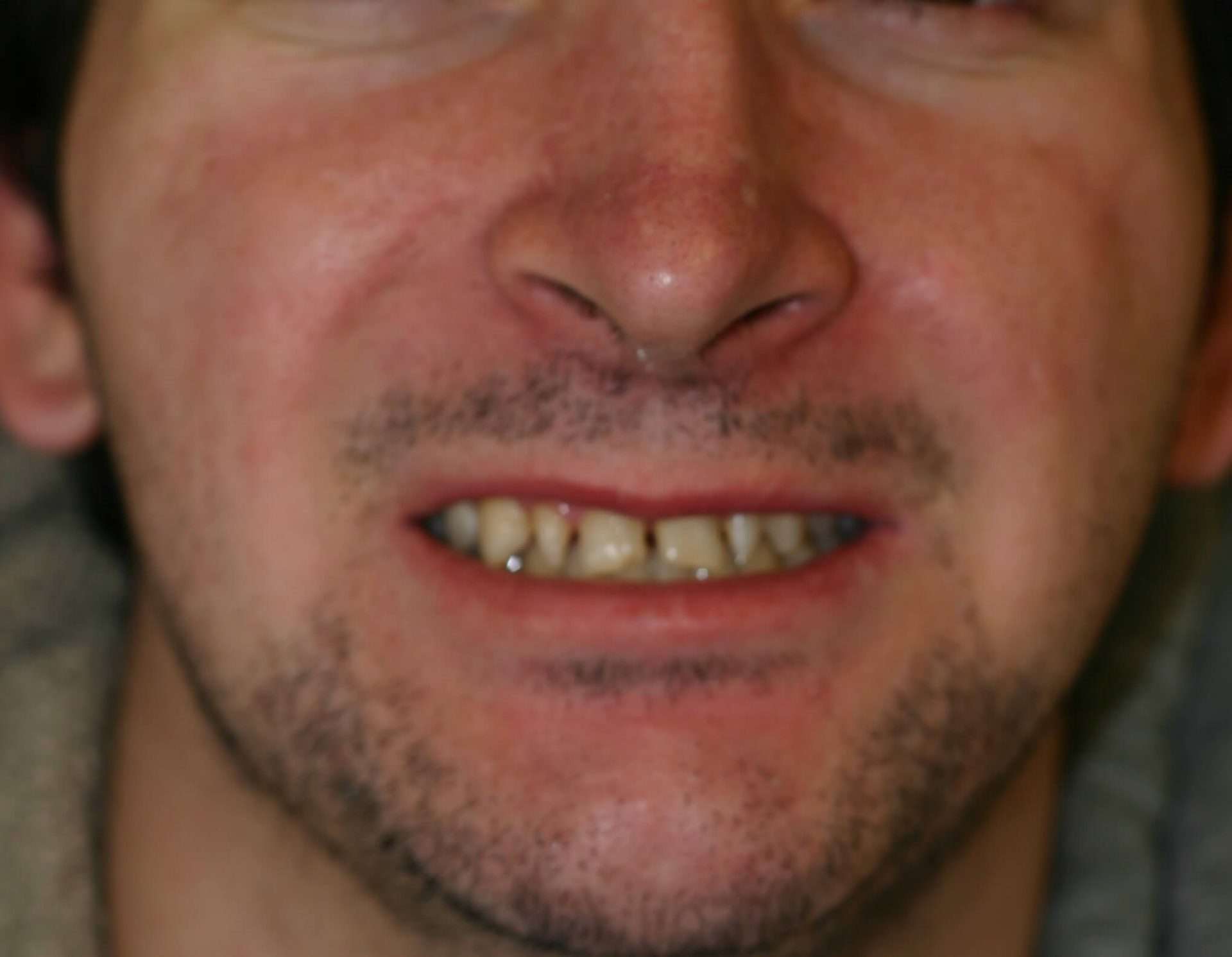 Modern Dentistry can overcome & create perfection! Come see us in Woodland Hills - Before and after image 5 of 6