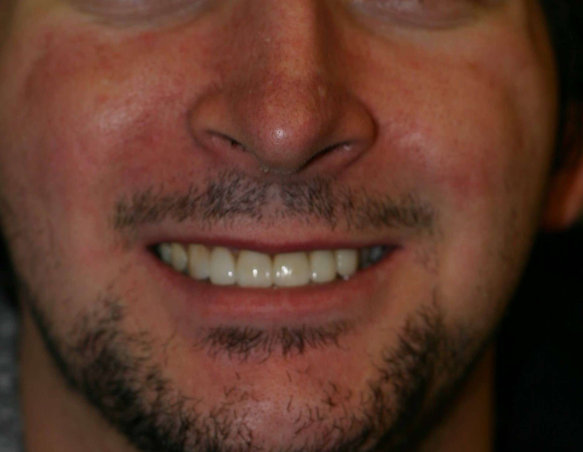 Modern Dentistry can overcome & create perfection! Come see us in Woodland Hills - Before and after image 6 of 6