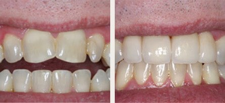 Dr. Fredericks Rejuvenates Man's Smile - Before and after image 1 of 1