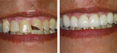 Bell Canyon resident needed smile makeover - Before and after image 1 of 1