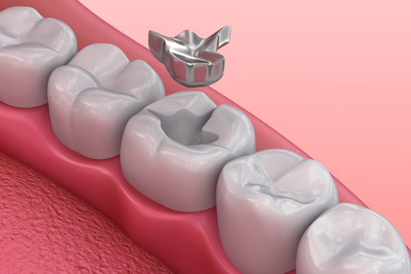 Advances In Tooth Colored Filling Technology