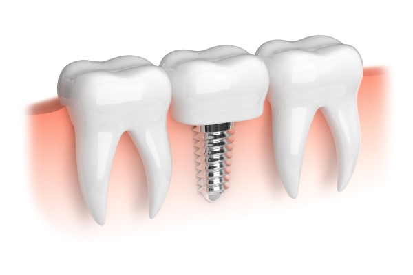 When A Bone Graft For Dental Implant Restoration May Be Recommended